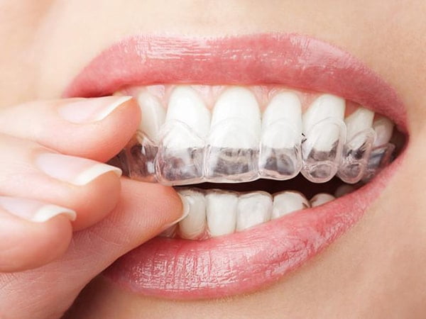 Bọc răng sứ rất đơn giản có thể tự làm tại nhà