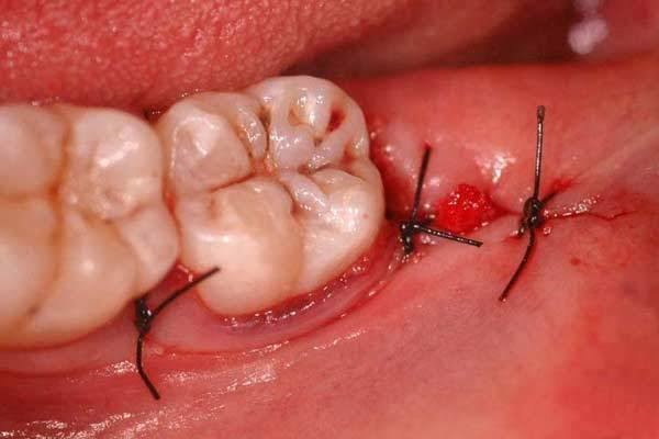 Quá trình thực hiện việc cắt chỉ rất nhanh chóng và đơn giản cho nên bạn sẽ không cảm thấy bị đau