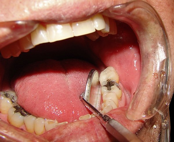 Khi đau răng hàm tốt nhất bạn nên đến gặp nha sĩ để trị dứt điểm cơn đau