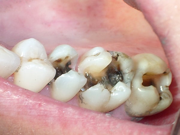 Sâu răng là một bệnh lý chứa nhiều vi khuẩn dẫn đến đau răng hàm