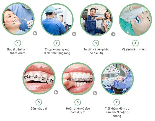 Quy trình niềng răng gồm các bước đơn giản