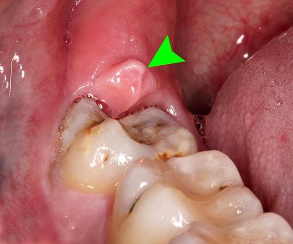 Răng khôn thường nằm sâu ở trong hàng răng hàm lớn được gọi là răng số 8