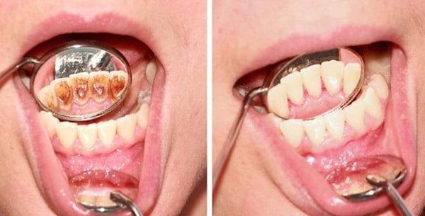 Khi răng ố vàng và có cao răng đều là sự bắt đầu của một số bệnh về răng lợi