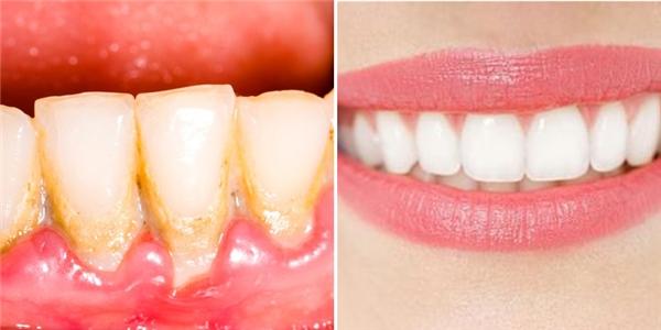 Chia sẻ cách làm răng trắng bóng trong 5 phút hiệu quả không tốn nhiều chi phí!