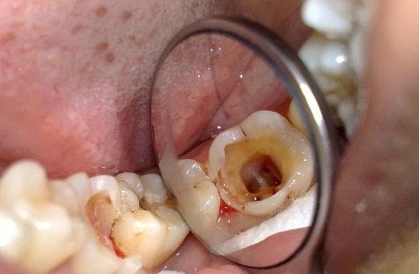Khi đau răng hàm thì nguyên nhân đầu tiên được chỉ đích ra, đó chính là sâu răng