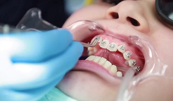 quy trình niềng răng