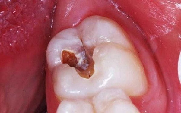 Viêm tủy là một trong những dấu hiệu gây nên bệnh đau răng và cần phải được chữa trị kịp thời