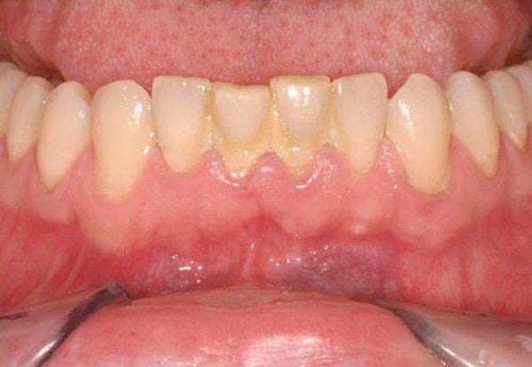 Dẫn đến một số bệnh lý nguy hiểm nếu không kịp thời lấy cao răng Dẫn đến một số bệnh lý nguy hiểm nếu không kịp thời lấy cao răng