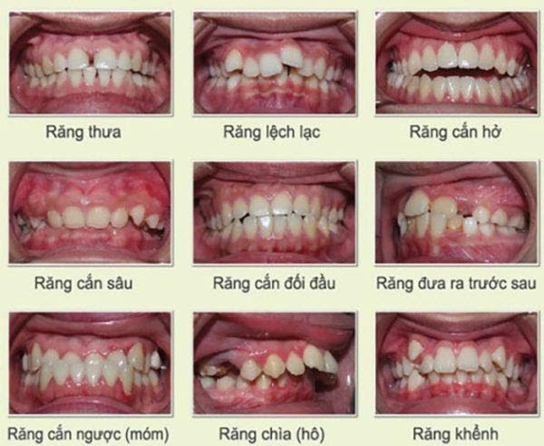 Mỗi một đối tượng sẽ đưa ra một liệu trình thời gian niềng răng khác nhau