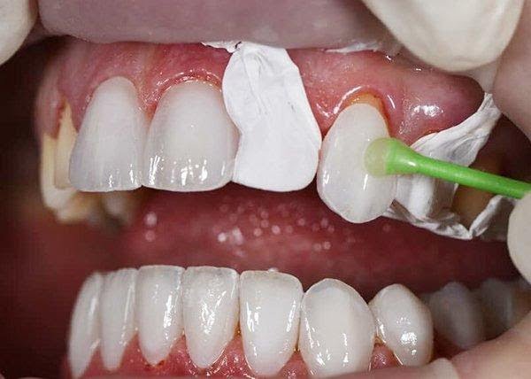 Lắp mão răng sứ không đúng gờ rãnh hoặc bị cộm cao sẽ khiến bạn cảm thấy khó chịu Lắp mão răng sứ không đúng gờ rãnh hoặc bị cộm cao sẽ khiến bạn cảm thấy khó chịu