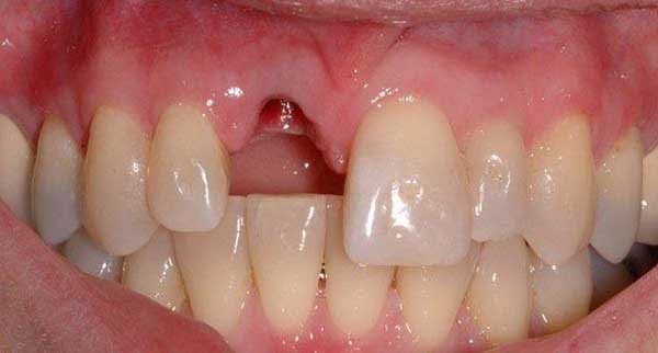 Bọc răng sứ giúp khả năng nhai và khôi phục lại những chiếc răng đã gãy trở lại bình thường