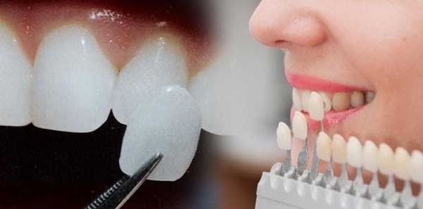 Gắn răng sứ không chỉ giúp bạn thoải mái nhất trong lúc nhai mà còn mang tính thẩm mỹ cao