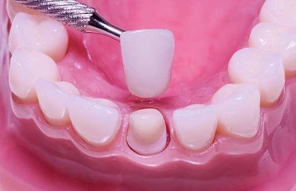 Bọc răng sứ giúp bảo vệ cho cả hàm răng luôn chắc khỏe Bọc răng sứ giúp bảo vệ cho cả hàm răng luôn chắc khỏe
