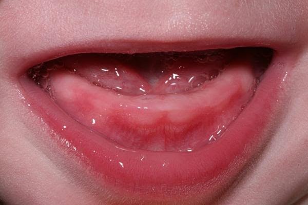 Nướu bị sưng căng, đỏ mọng khi trẻ mọc răng