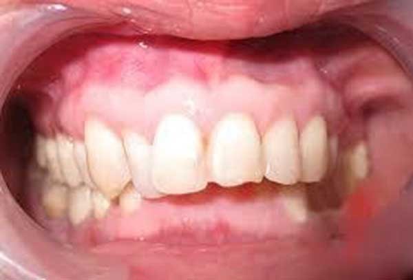 Trường hợp tẩy răng trắng nhưng không có kết quả do nhiễm kháng sinh nên bọc răng sứ Trường hợp tẩy răng trắng nhưng không có kết quả do nhiễm kháng sinh nên bọc răng sứ