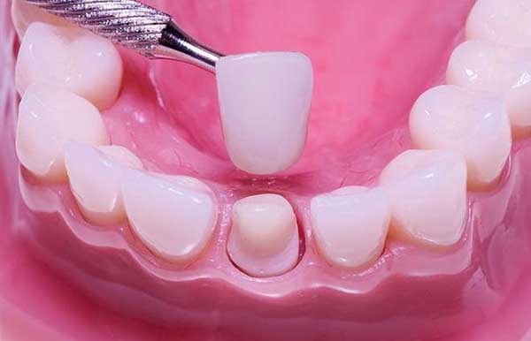Bọc răng sứ giúp bảo vệ cho cả hàm răng luôn chắc khỏe