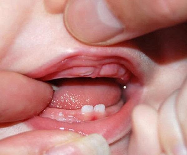 Dấu hiệu trẻ mọc răng? Dấu hiệu nhận biết khi bé mọc răng
