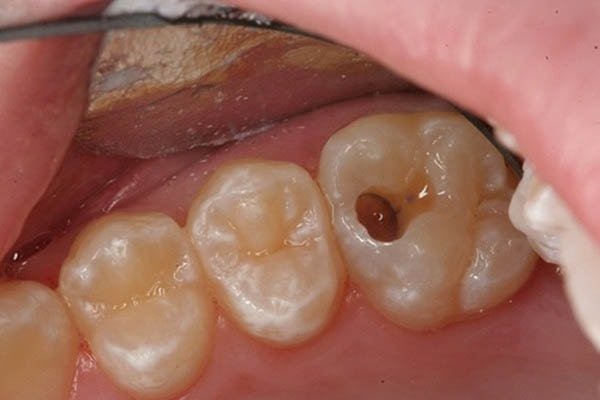 Đau răng hàm là một hiện tượng gây ra những cơn đau đớn khó chịu