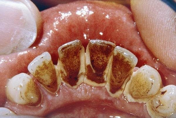 Mảng bám hình thành trên bề mặt răng