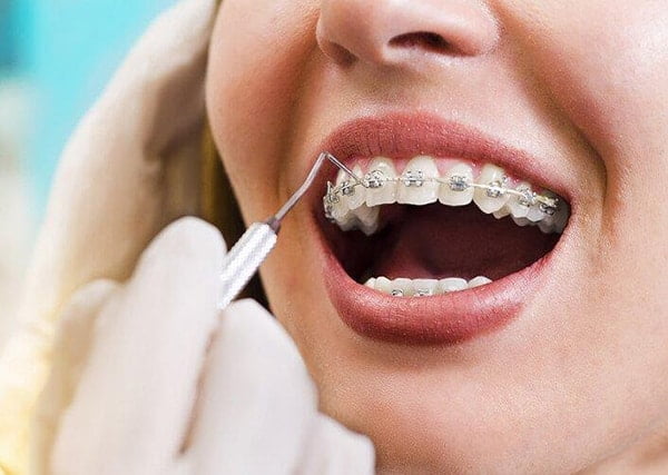 Niềng răng chính là dùng khí cụ để tiến hành kỹ thuật chỉnh nha.