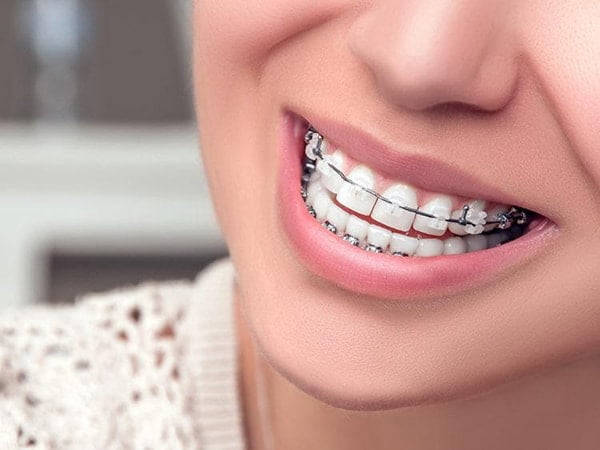 Trong quá trình niềng răng, bạn cần phải kiên nhẫn để có một hàm răng đều và đẹp