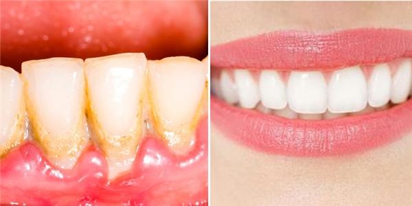 Chia sẻ cách làm răng trắng bóng trong 5 phút hiệu quả không tốn nhiều chi phí!
