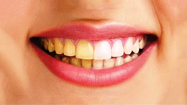 Răng vàng : Nguyên nhân & Cách làm trắng răng bị vàng